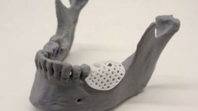 Um modelo demonstrando onde o andaime impresso em 3D pode ser colocado em uma mandíbula.