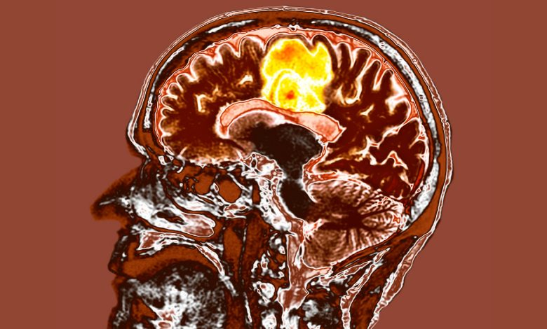 Novo tratamento para o câncer cerebral mais agressivo pode ajudar os pacientes a viver mais